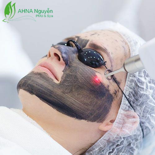 Phương pháp laser carbon