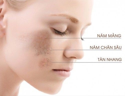 NÁM DA Ở TUỔI TRUNG NIÊN - TÌM HIỂU VỀ SẠM NÁM DA