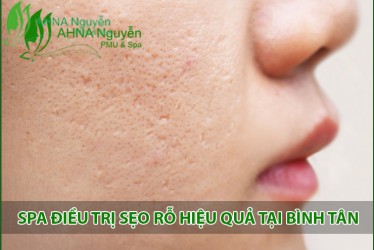 Spa điều trị sẹo rỗ hiệu quả tại Bình Tân