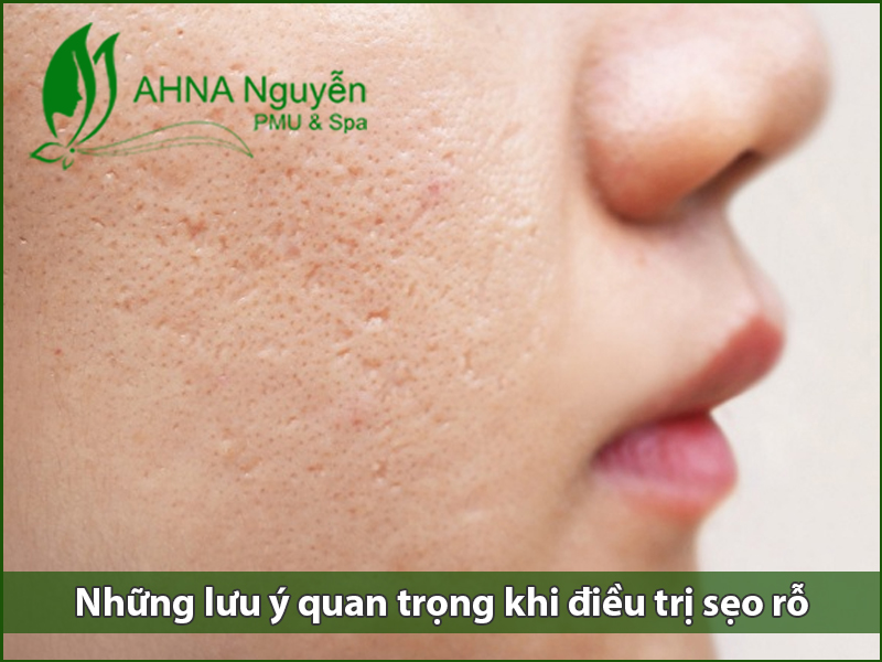 Những lưu ý quan trọng khi điều trị sẹo rỗ